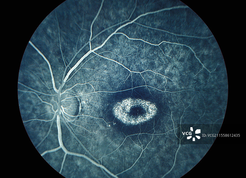 斯塔加特病，眼底血管造影图片素材