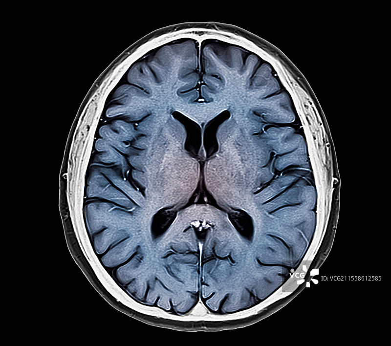 人脑，基底神经节，MRI扫描图片素材