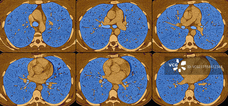 正常的肺部和心脏，CT扫描图片素材