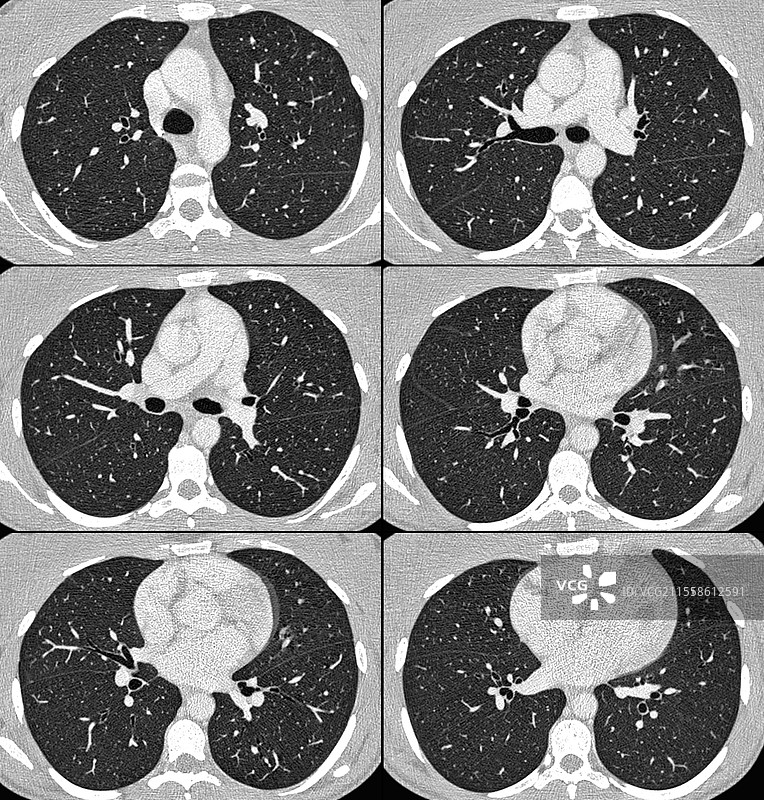 正常的肺部和心脏，CT扫描图片素材