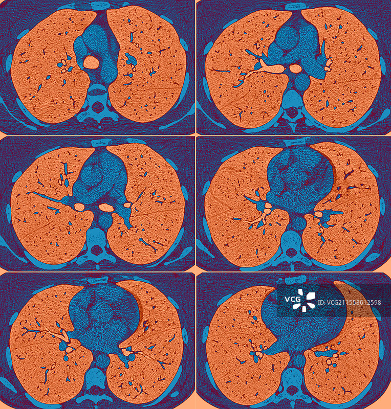 正常的肺部和心脏，CT扫描图片素材
