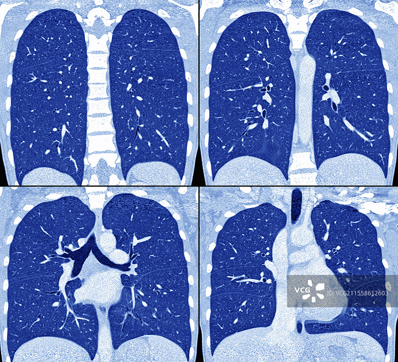 正常的肺部和心脏，CT扫描图片素材