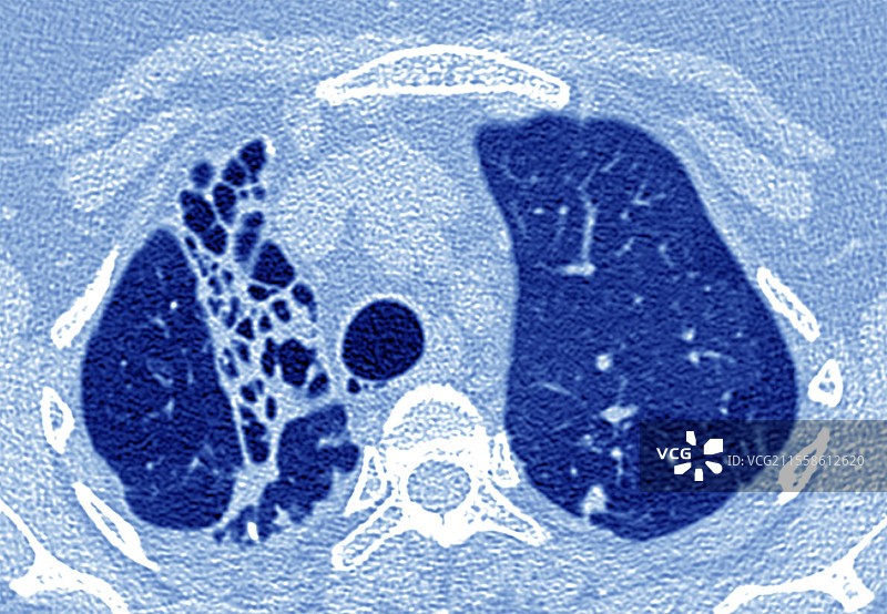 肺结核导致的肺损伤，CT扫描图片素材