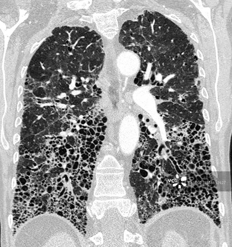 类风湿关节炎中的常见间质性肺炎，CT扫描图片素材