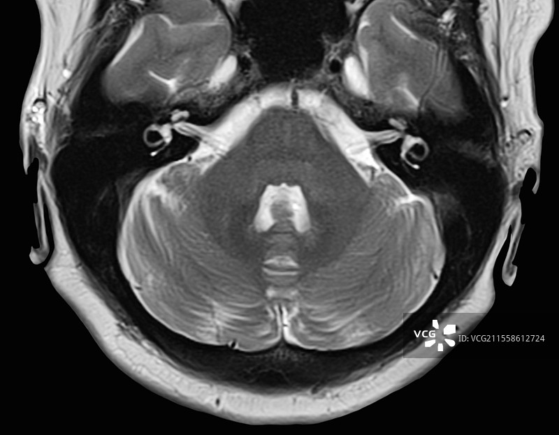 人脑、脑小脑和脑干的MRI扫描图片素材