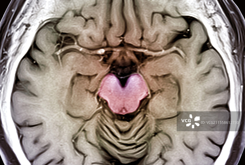 人脑，中脑，MRI扫描图片素材
