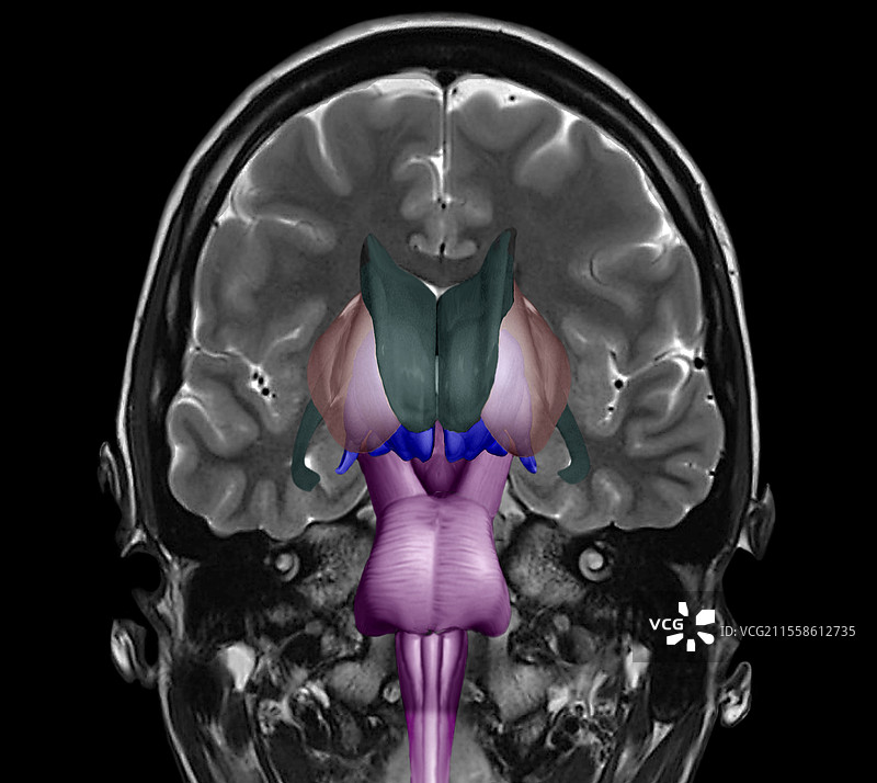 人脑和脑干，MRI扫描图片素材