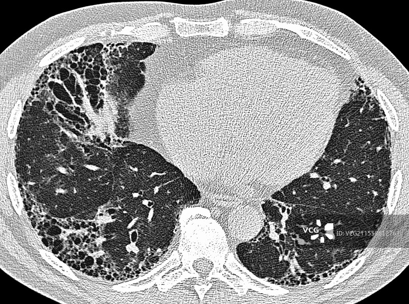 类风湿关节炎中的常见间质性肺炎，CT扫描图片素材