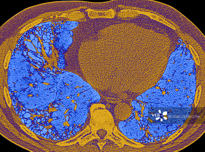 类风湿关节炎中的常见间质性肺炎，CT扫描图片素材