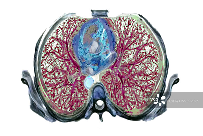 支气管树，3D CT扫描图片素材