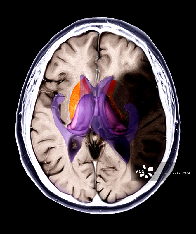 中风导致的脑损伤，MRI扫描图片素材