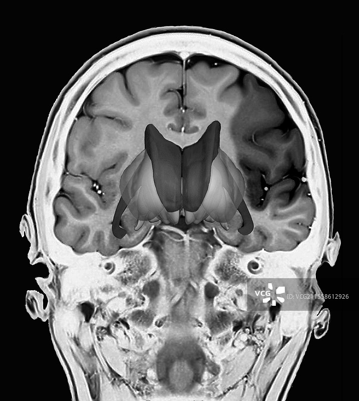 中风导致的脑损伤，MRI扫描图片素材