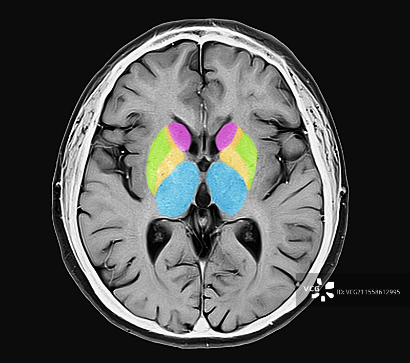 人脑，MRI扫描图片素材