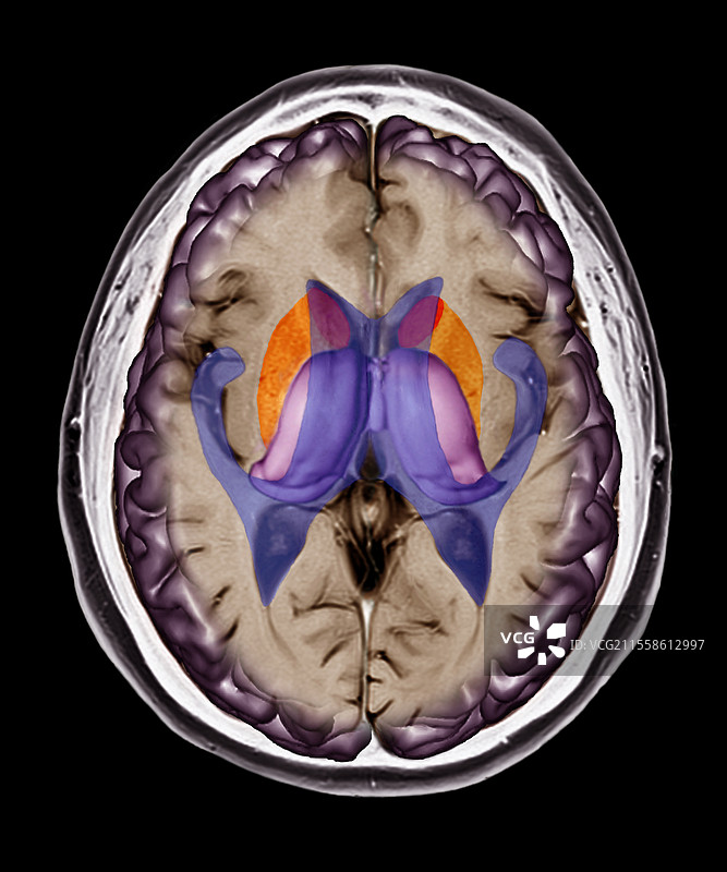 人脑，MRI扫描图片素材