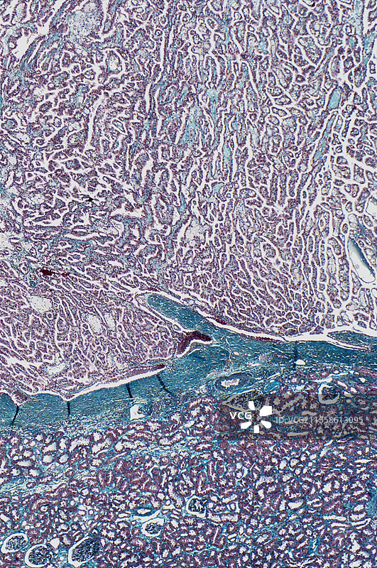 肾癌，光学显微镜图像图片素材