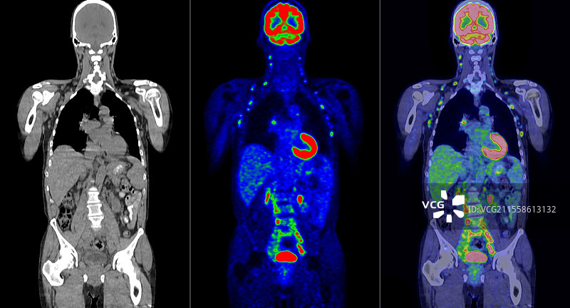 滤泡性淋巴瘤，CT和PET扫描图片素材
