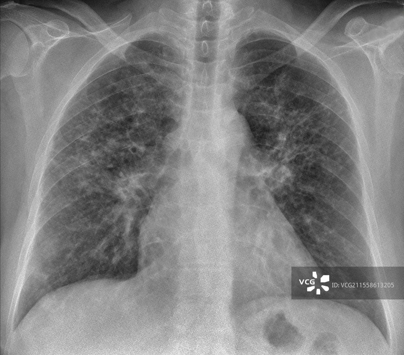 肉芽肿病引起的间质性肺炎，肺部X光片图片素材