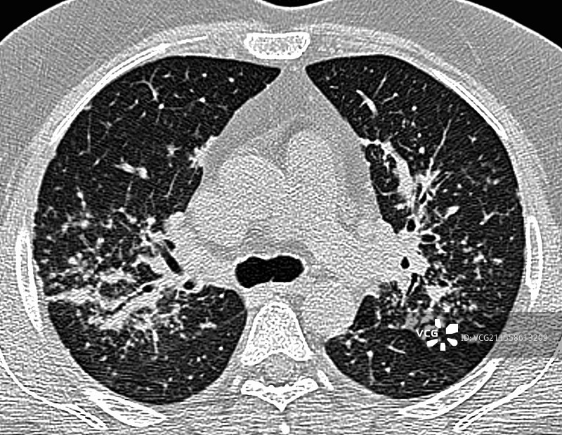 结节病间质性肺炎，肺部CT扫描图片素材