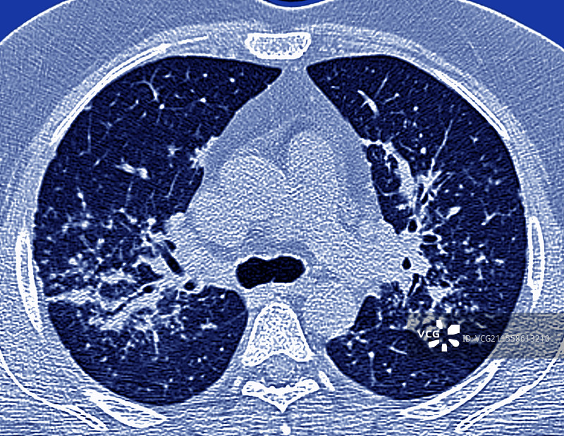 结节病间质性肺炎，肺部CT扫描图片素材