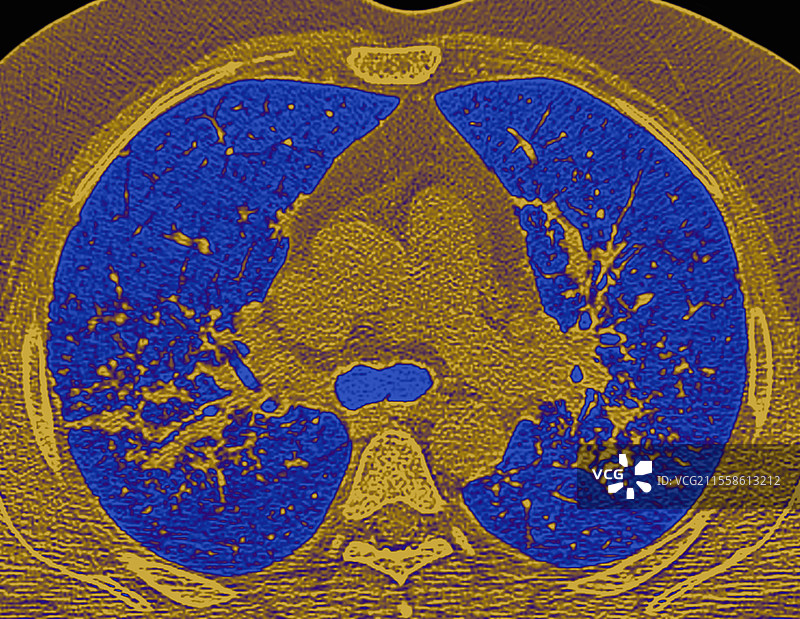 结节病间质性肺炎，肺部CT扫描图片素材