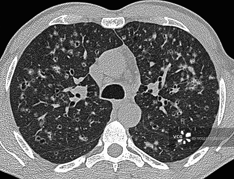 肺部朗格汉斯细胞组织细胞增生症，肺部CT扫描图片素材