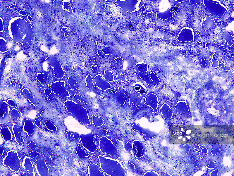 甲状腺腺泡腺瘤，光学显微镜图像图片素材
