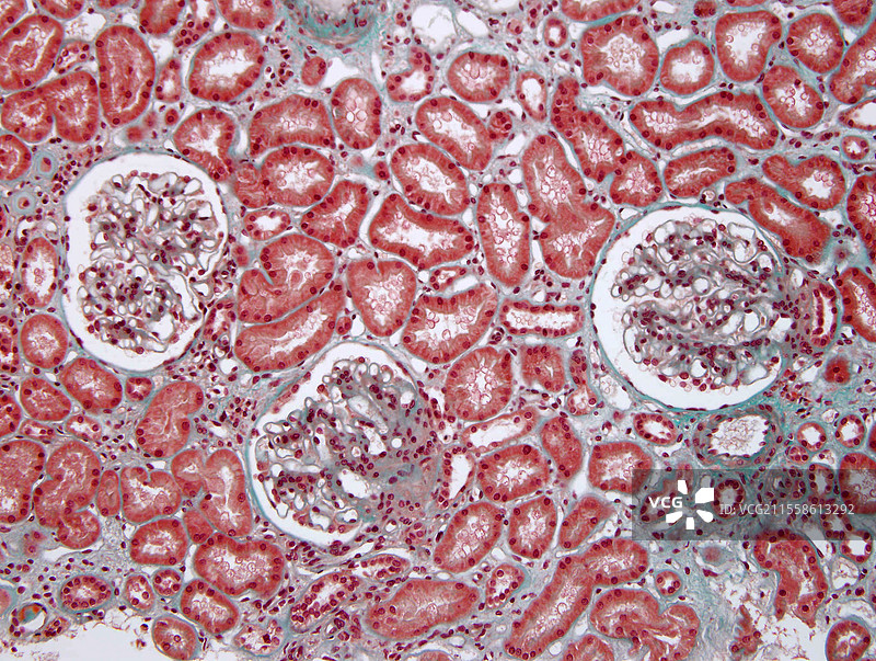 节段性肾小球肾炎，光学显微镜下图像图片素材