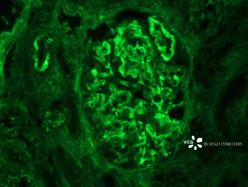 狼疮性肾炎中的肾小球，免疫荧光图片素材