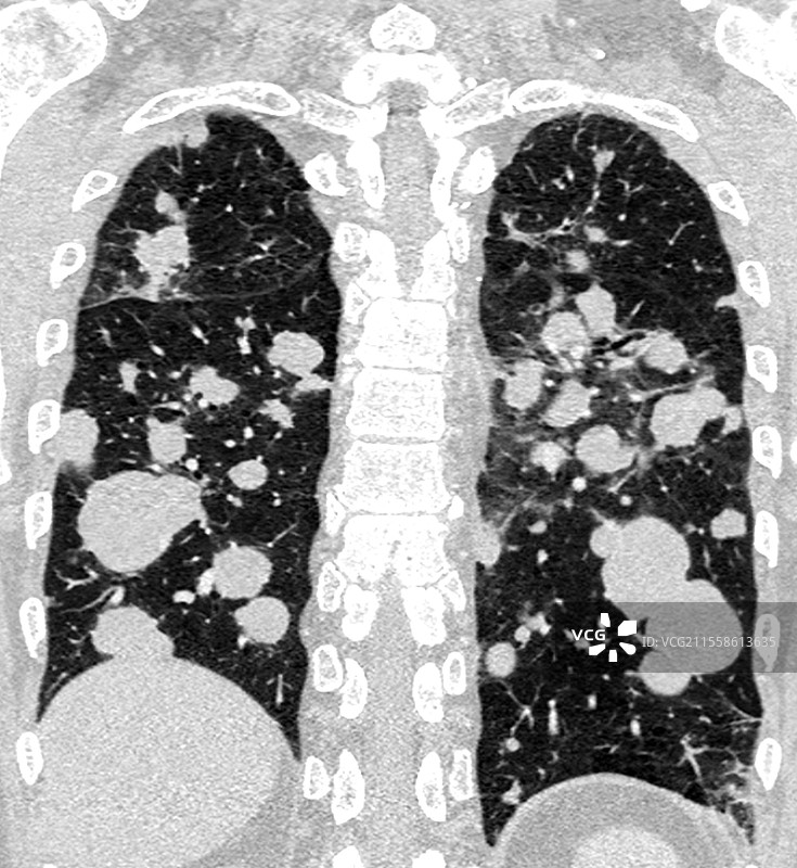 继发性肺癌，CT扫描图片素材