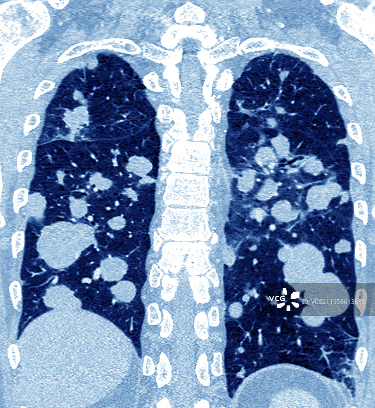 继发性肺癌，CT扫描图片素材