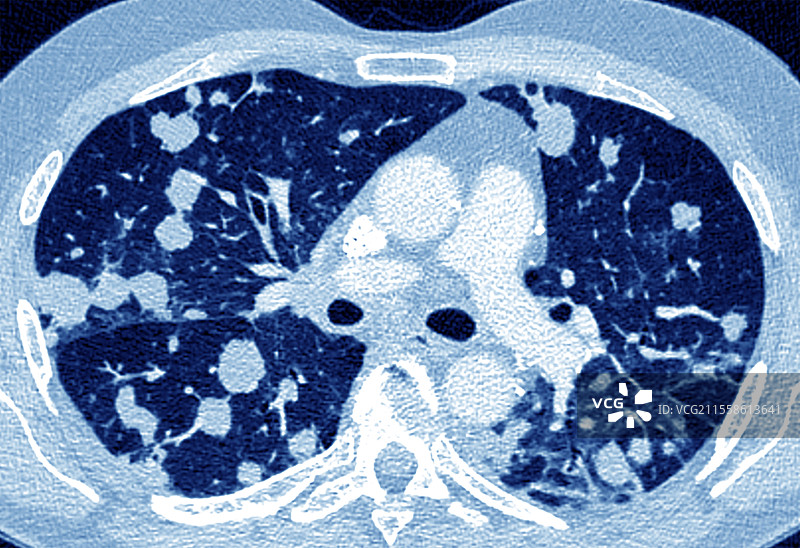 继发性肺癌，CT扫描图片素材