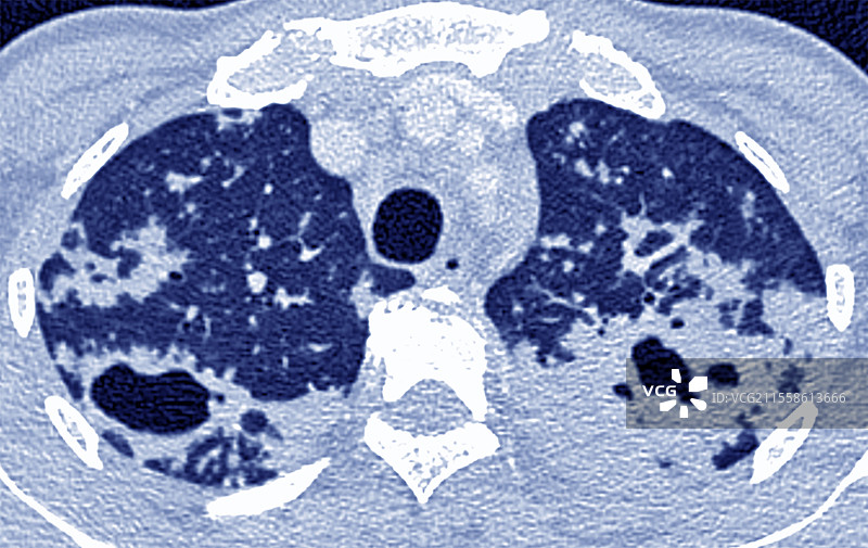 结核病，X光检查图片素材