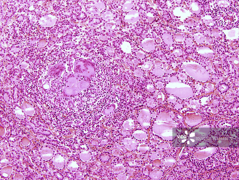 亚急性肉芽肿性甲状腺炎，光镜下图片素材