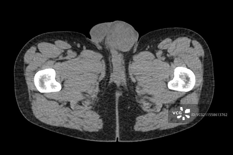 癌，CT扫描图片素材