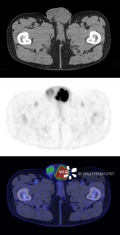 癌，CT和PET扫描图片素材