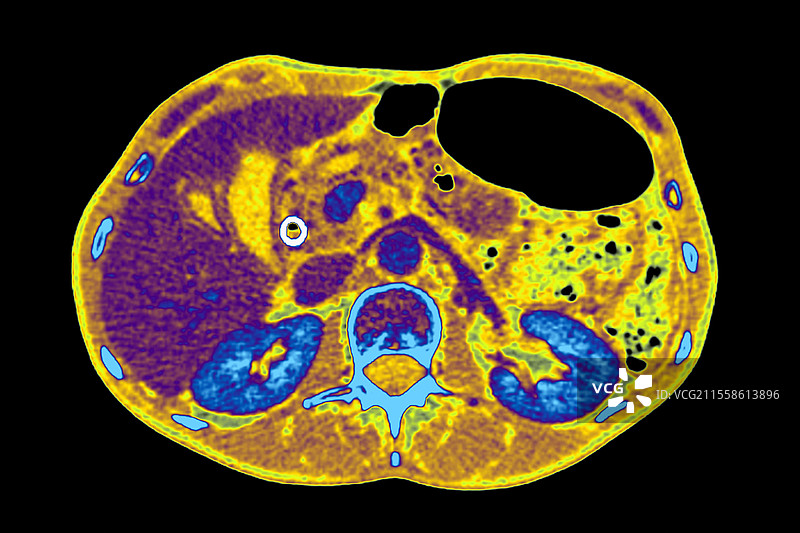 胰腺癌的胆总管旁路，CT扫描图片素材