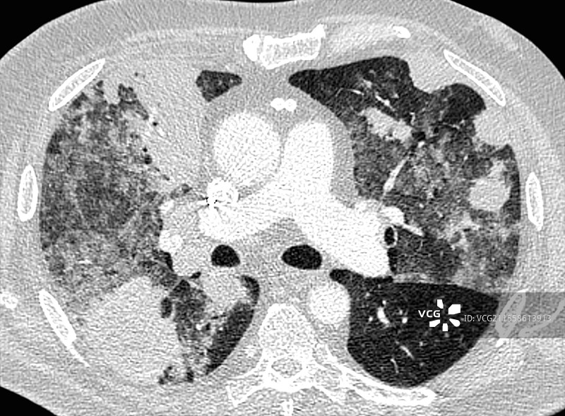 继发性肺癌，CT扫描图片素材