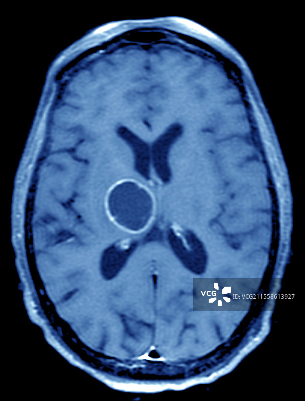 继发性脑癌，MRI扫描图片素材