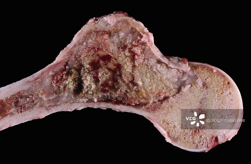 股骨头软骨肉瘤，标本观察图片素材