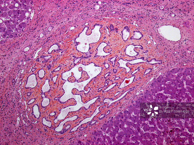 肝结节，光学显微镜图像图片素材