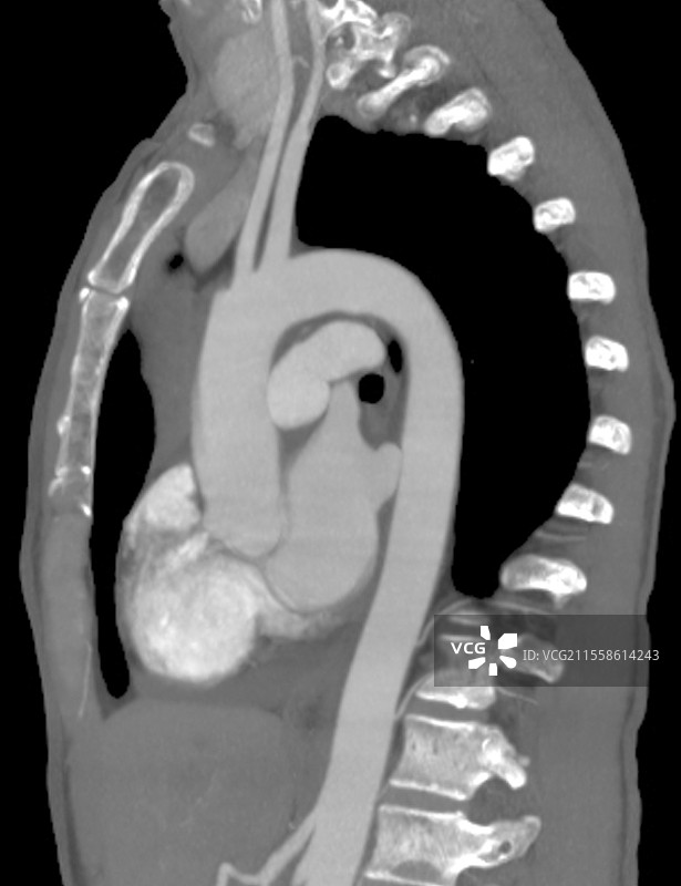 心脏和主动脉，CT扫描图片素材