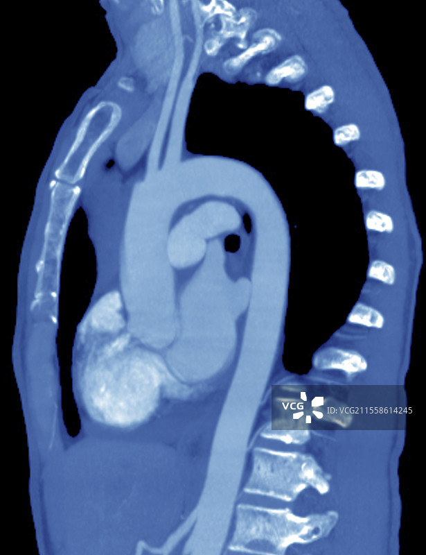 心脏和主动脉，CT扫描图片素材