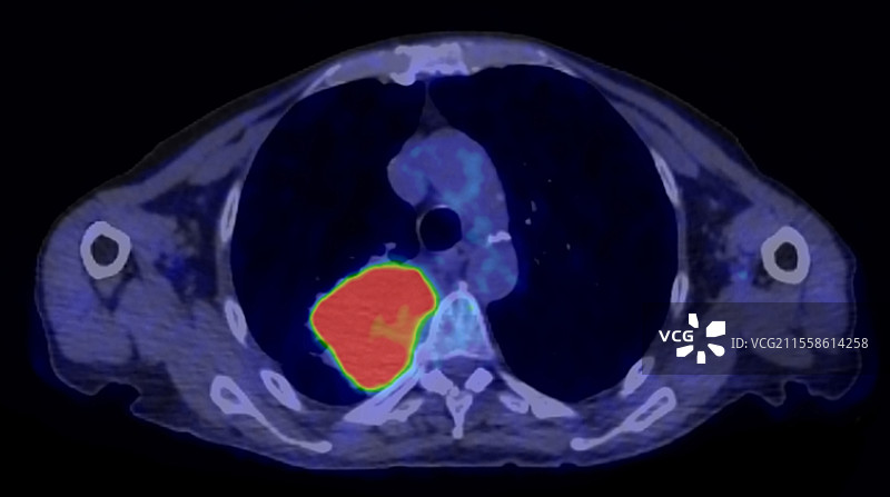 原发性腺癌肺癌，PET扫描图片素材
