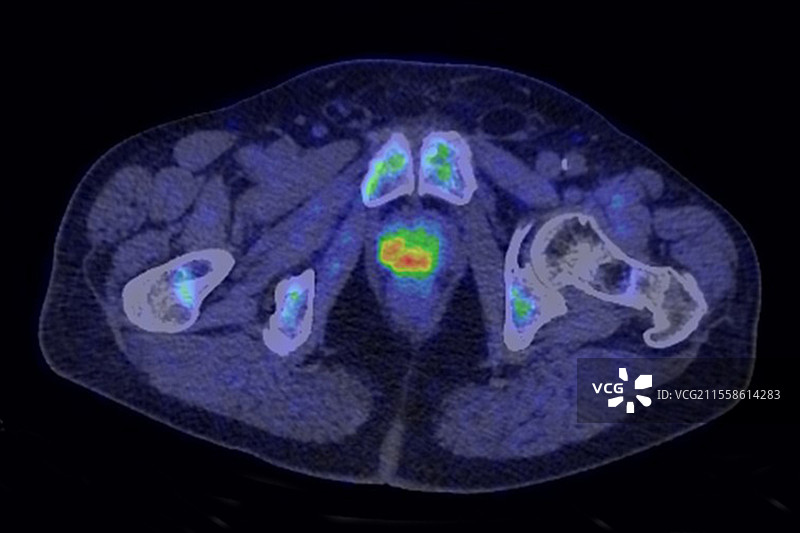 前列腺癌，CT-PET扫描图片素材