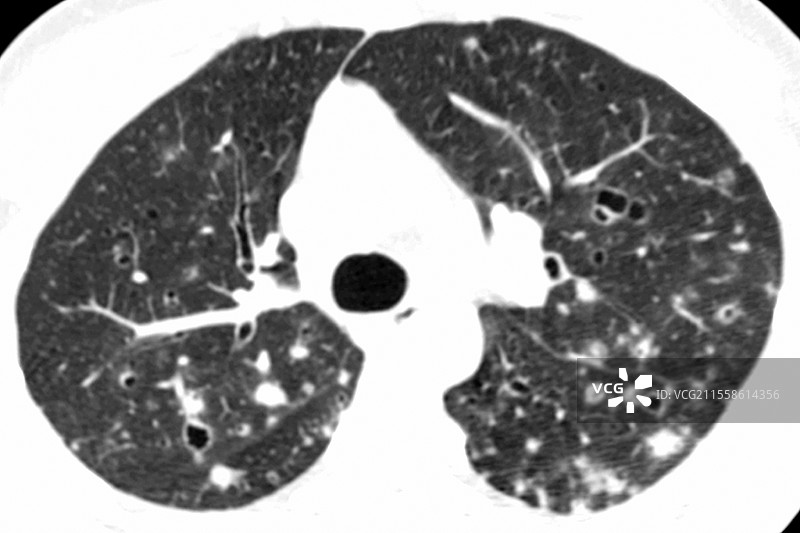 吸烟相关间质性肺炎，轴位胸部CT扫描图片素材