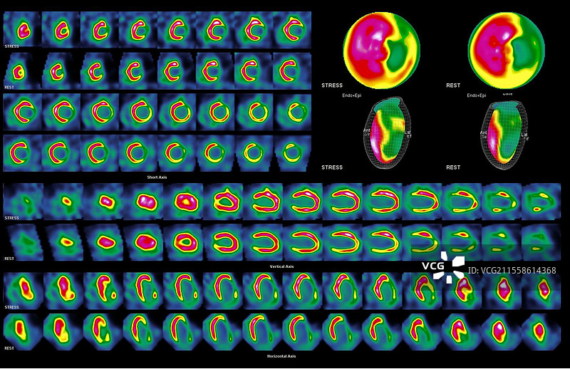 心脏病发作，SPECT扫描图片素材