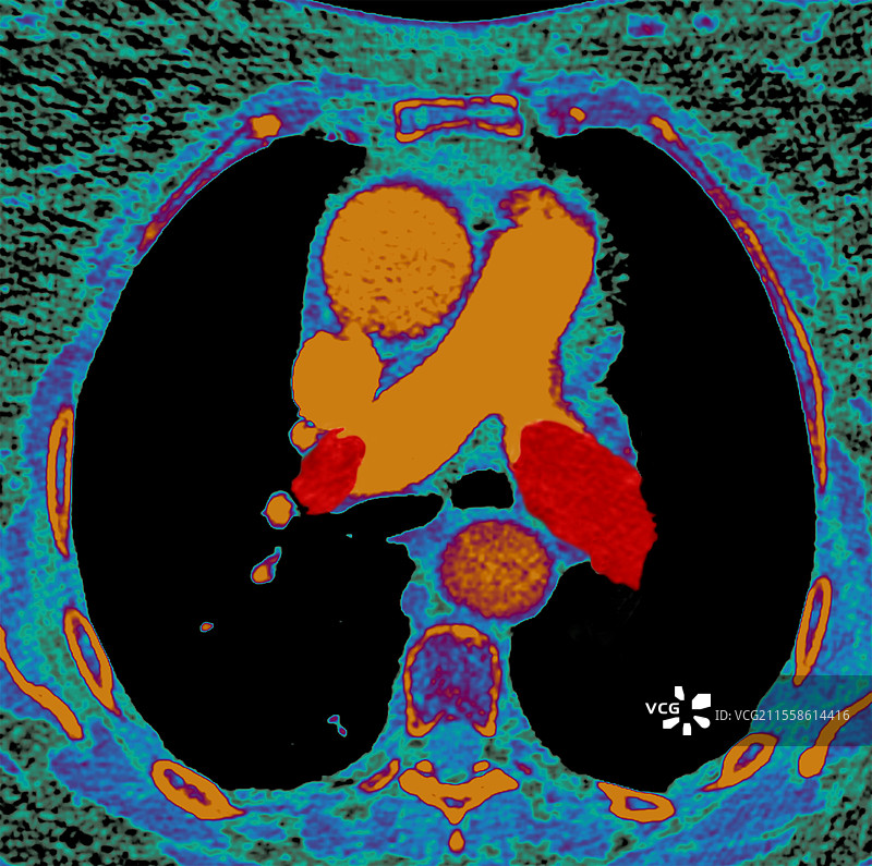 肺栓塞，轴位CT扫描图片素材