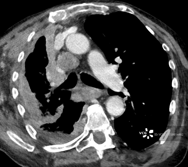 间皮瘤肺癌，CT扫描图片素材