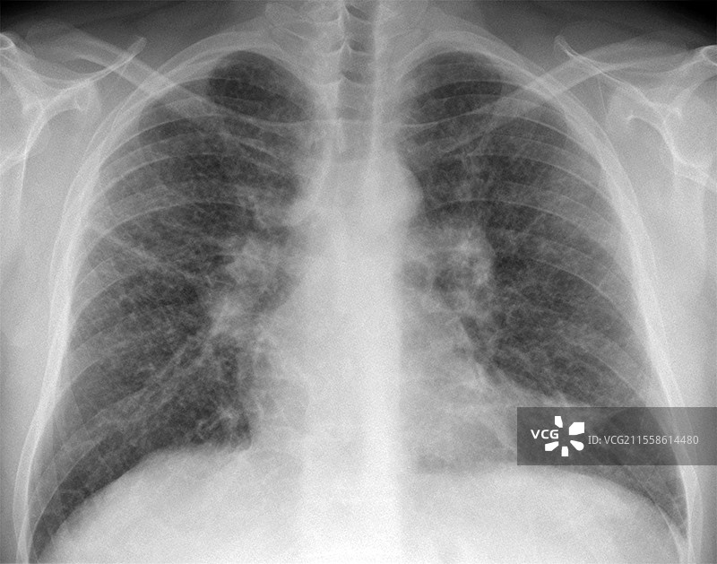 肺部肉芽肿病，X光检查图片素材