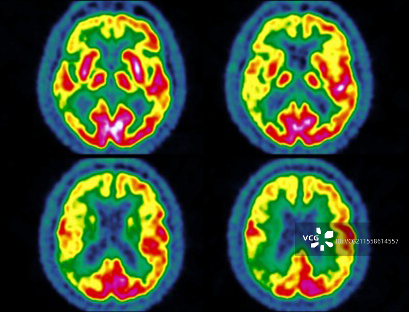 阿尔茨海默病，PET扫描图片素材